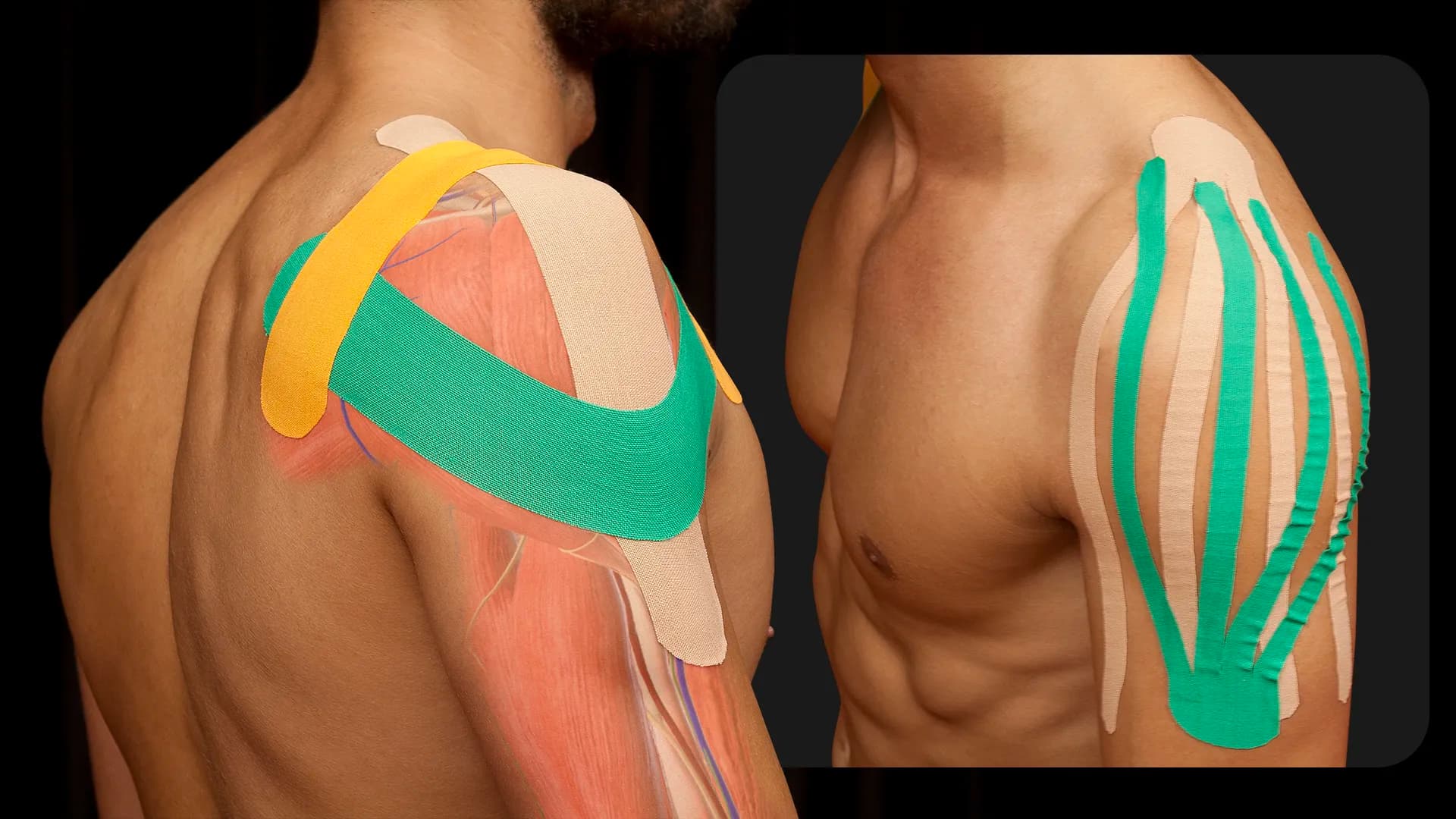 Conflitto subacromiale Taping Bendaggio neuromuscolare