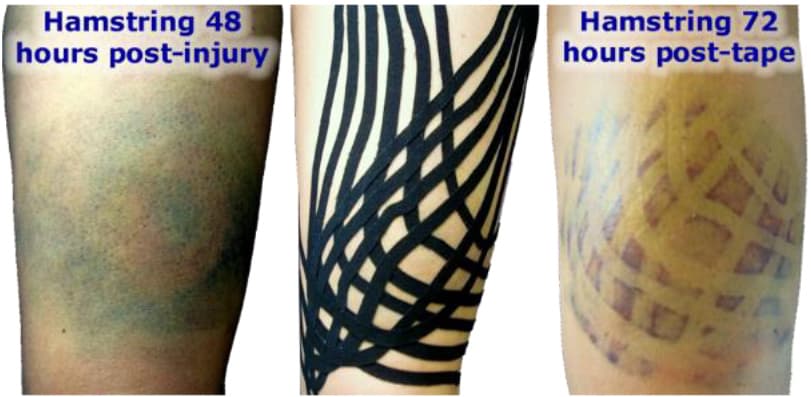Taping-Elastico-Effetto-Edema