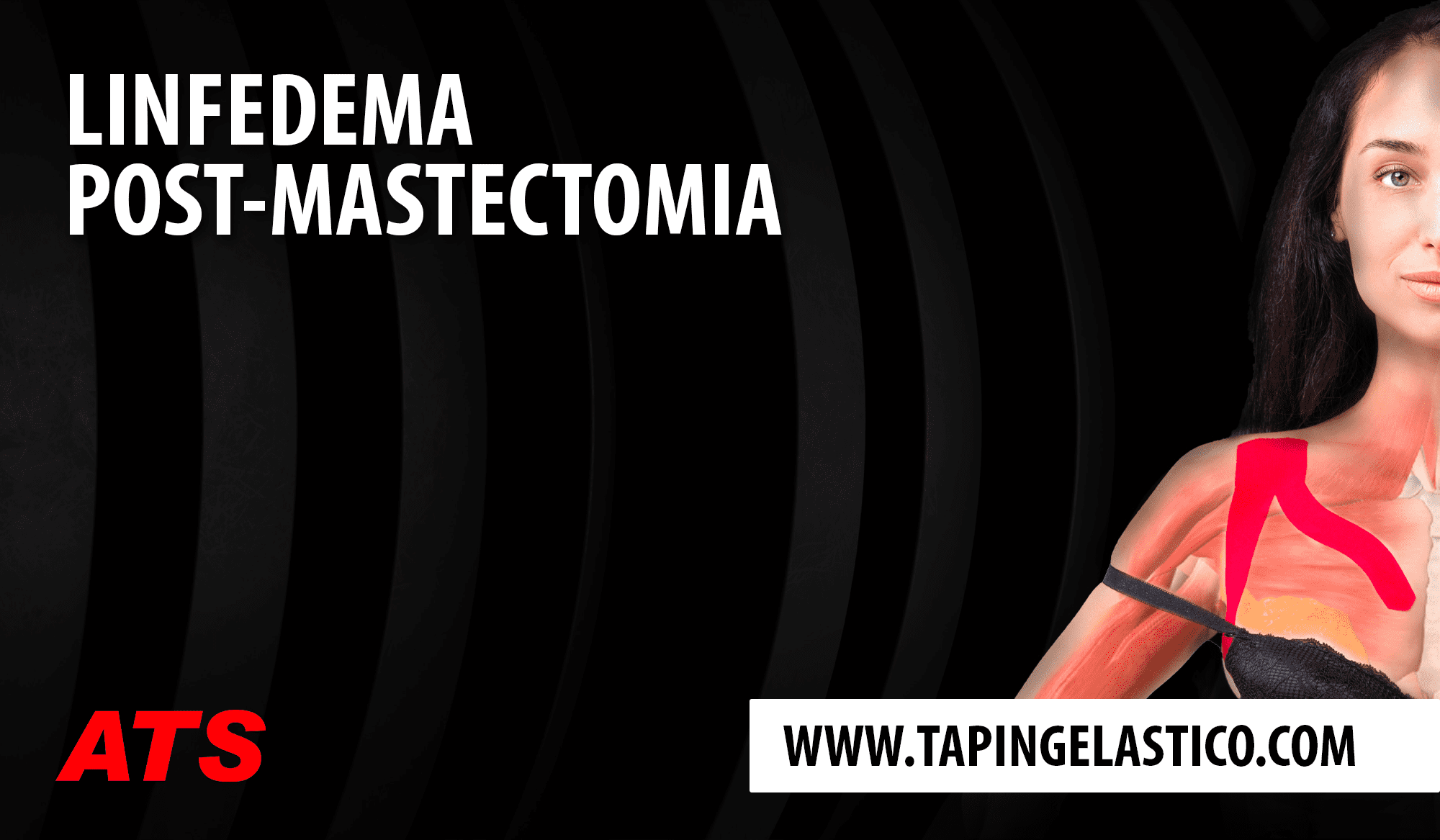 Effetti del Taping Elastico® su linfedema post-mastectomia